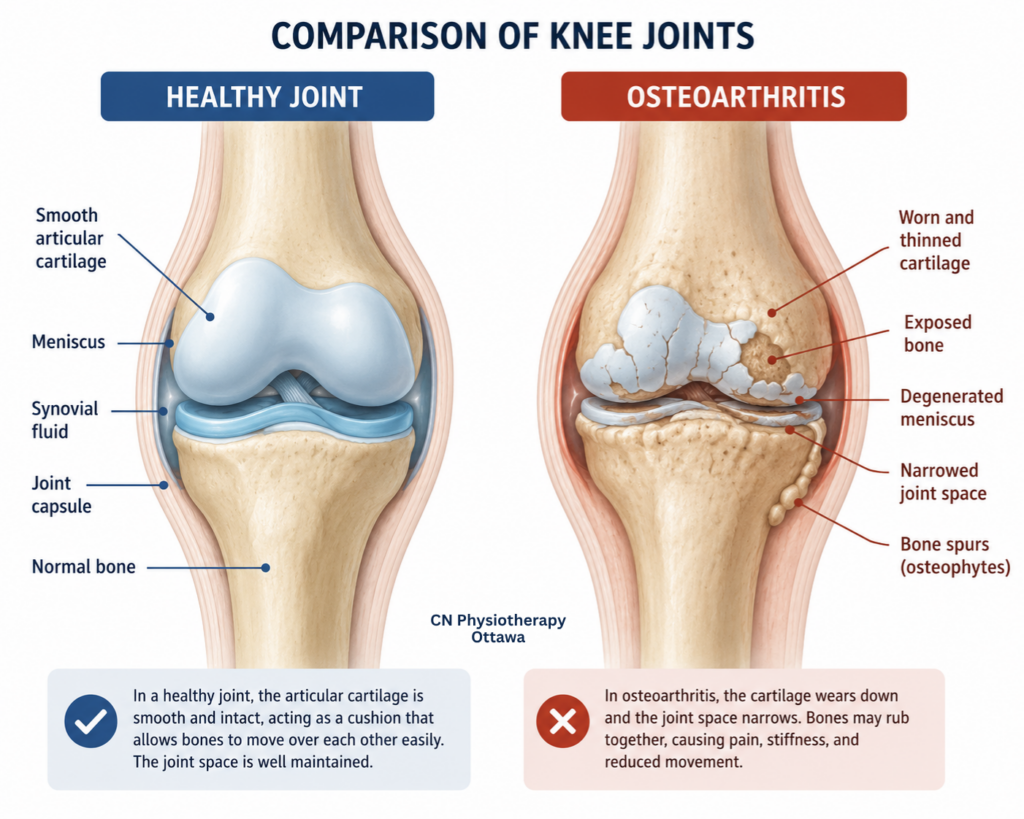 Comparison-of-a-healthy-joint-and-a-joint-affected-by-osteoarthritis