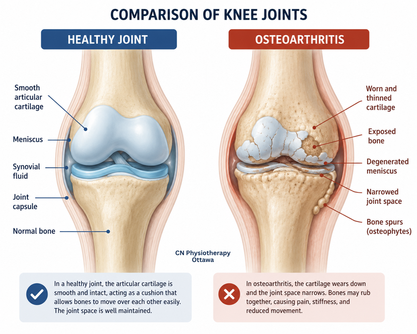 Comparison-of-a-healthy-joint-and-a-joint-affected-by-osteoarthritis